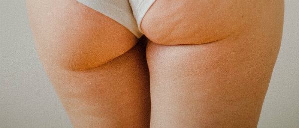 cellulite